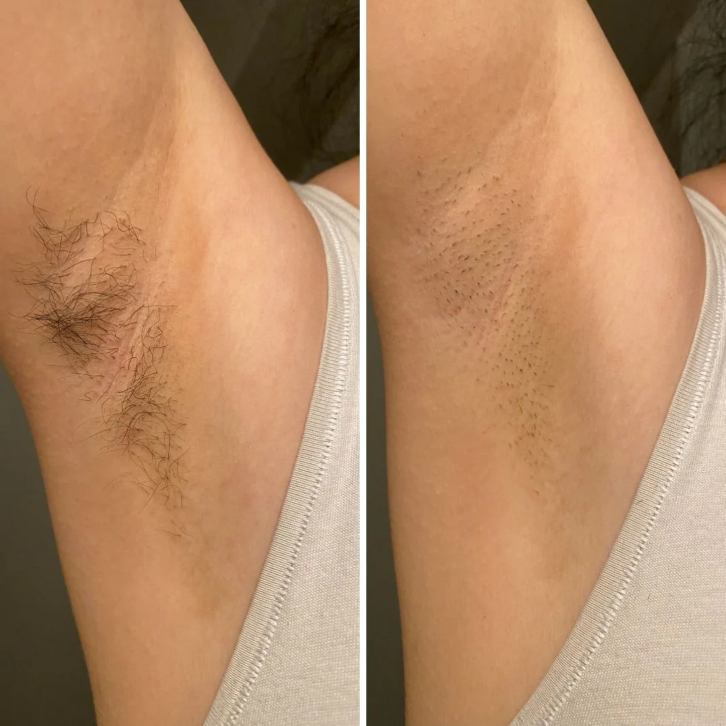 Bare Ease | Ontharingsapparaat 2-in-1 Draadloos en Compact 6