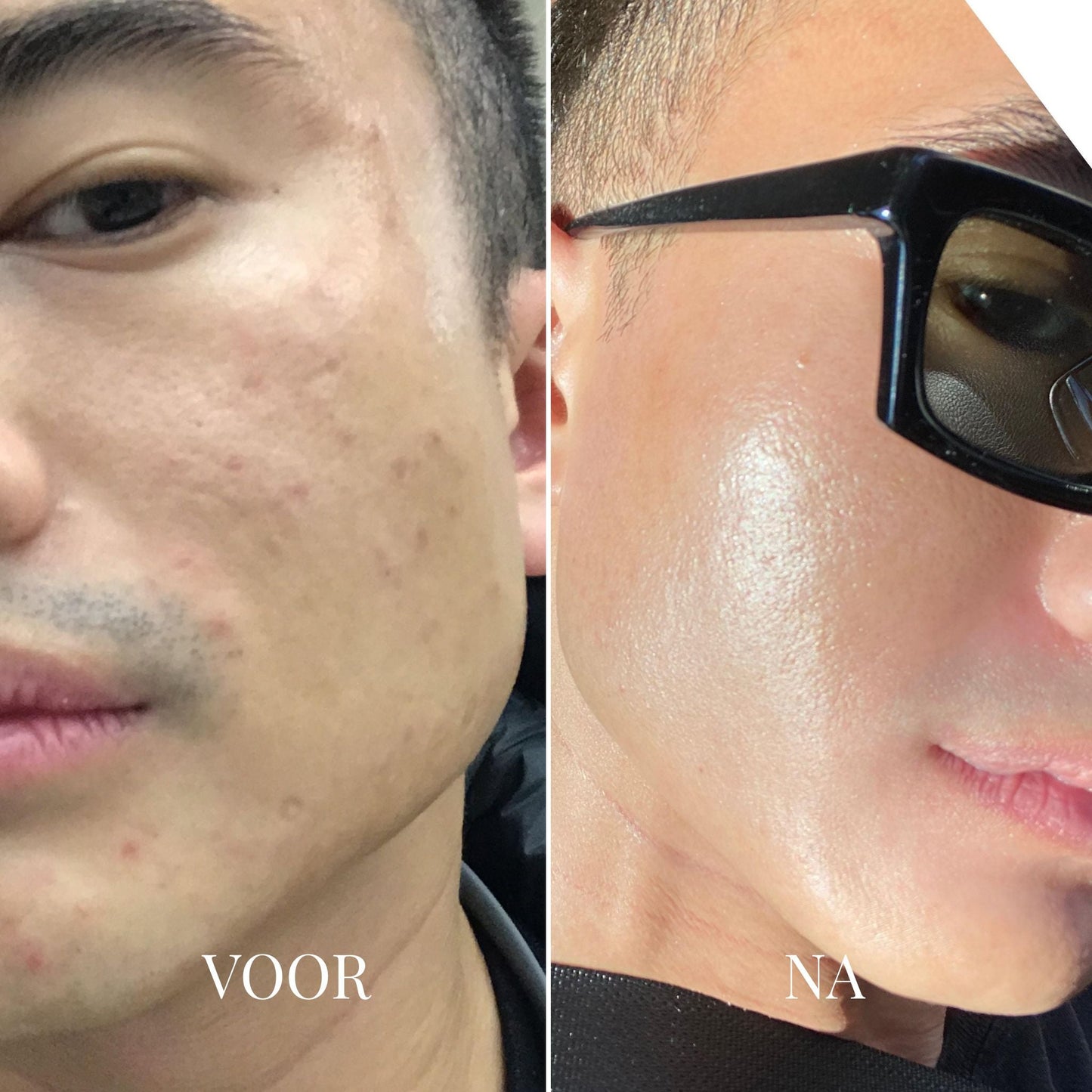 Porify Mee-Eter Verwijderaar | Huidverzorgingsapparaat 6