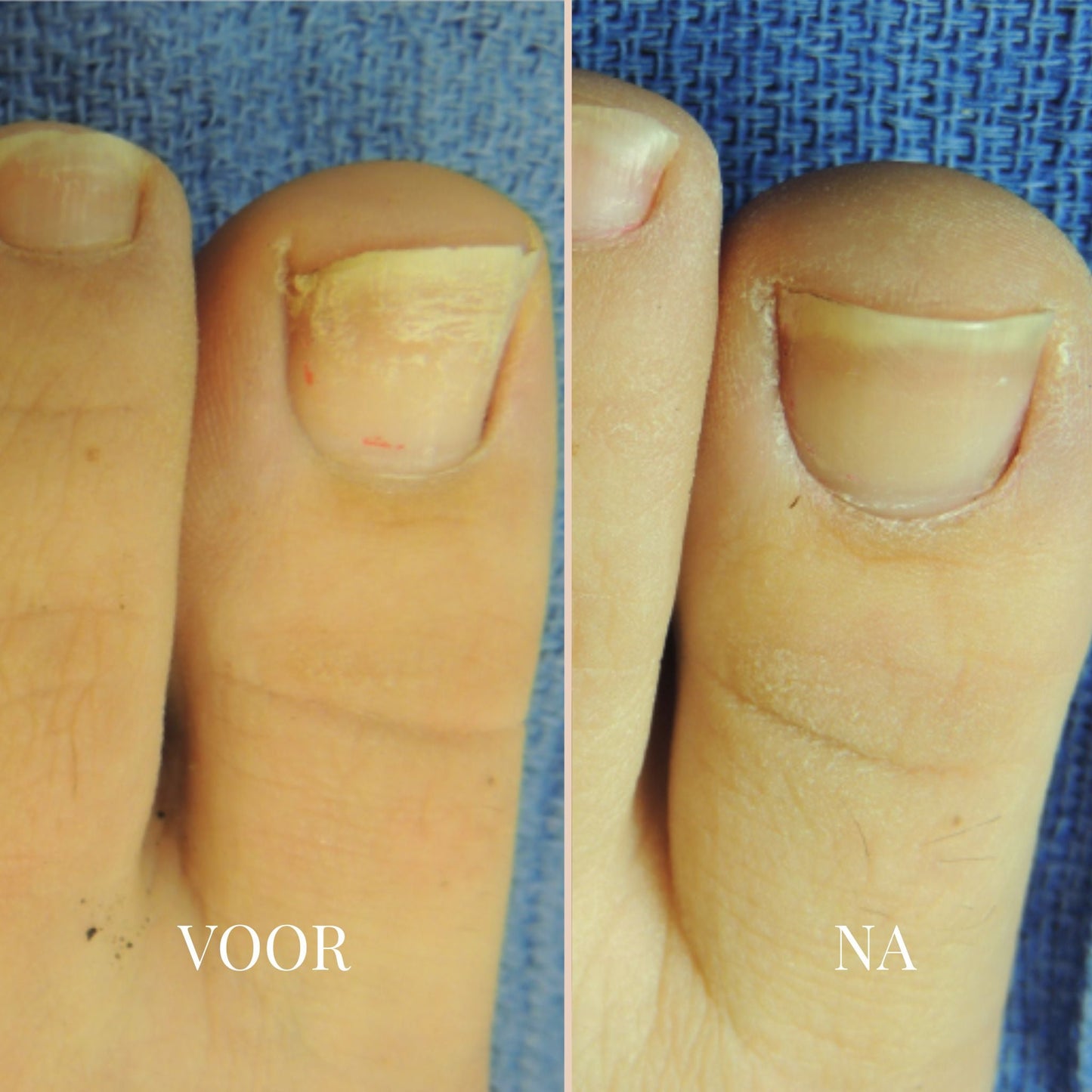 ReviveNail Herstelpleisters | Tegen Verkleurde Teennagels 6