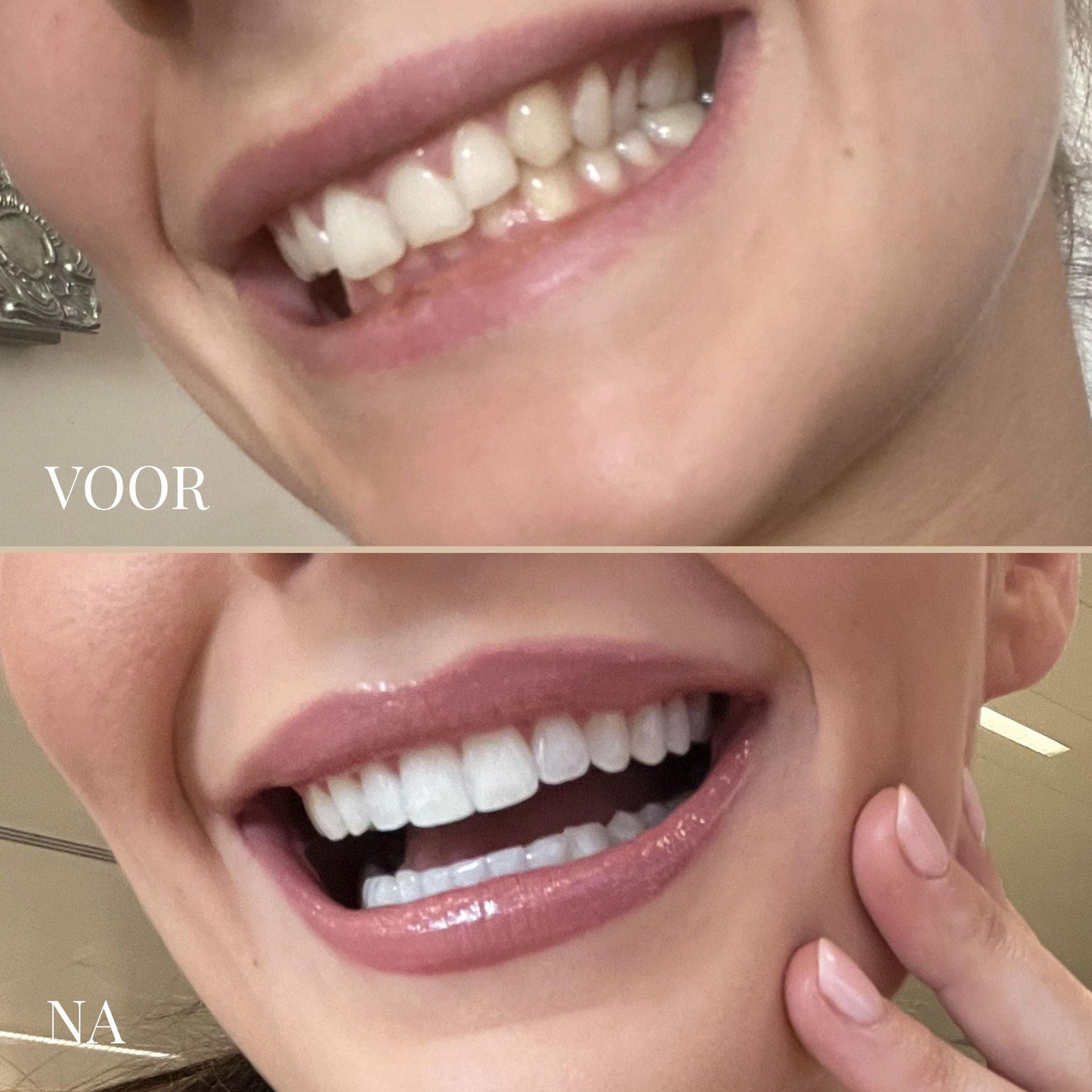 SmileSculpt | Beste Elektrische Tandenborstel Met Ultrasone Technologie 5