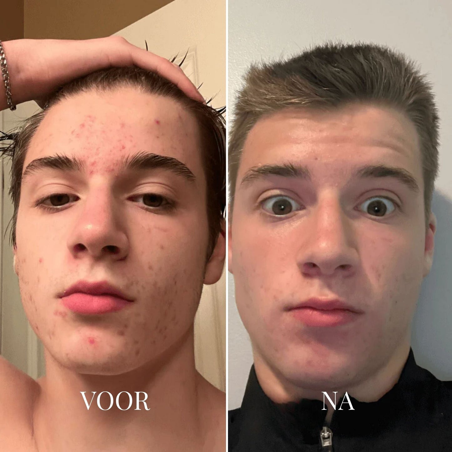 Porify Mee-Eter Verwijderaar | Huidverzorgingsapparaat 4