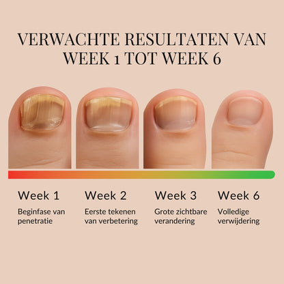 ReviveNail Herstelpleisters | Tegen Verkleurde Teennagels 1