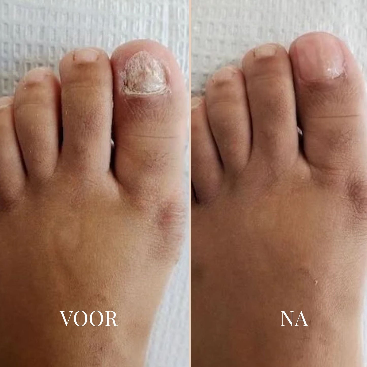 ReviveNail Herstelpleisters | Tegen Verkleurde Teennagels 4