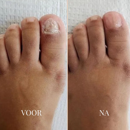 ReviveNail Herstelpleisters | Tegen Verkleurde Teennagels 4
