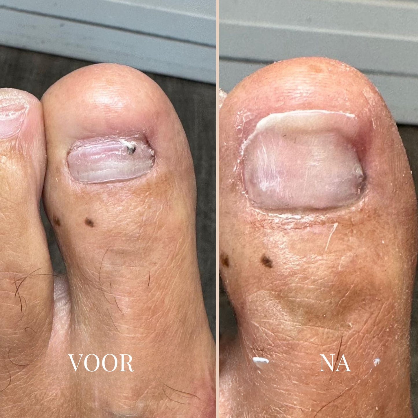 ReviveNail Herstelpleisters | Tegen Verkleurde Teennagels 5